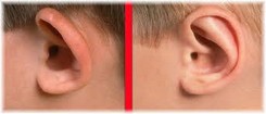 Kepçe Kulak Tedavisinde Ameliyatsız Sabitleme ve Ameliyat Yöntemi