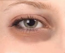 Göz altı morluklarının nedenleri ve doğal tedavi yöntemleri