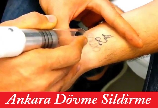 Ankara Lazerle Dövme Sildirme
