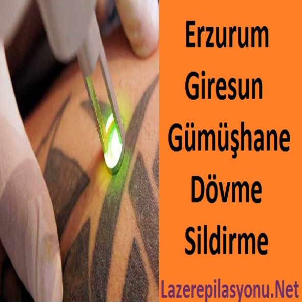Erzurum Giresun Gümüşhane Dövme Sildirme