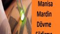 Malatya Manisa Mardin Dövme Sildirme
