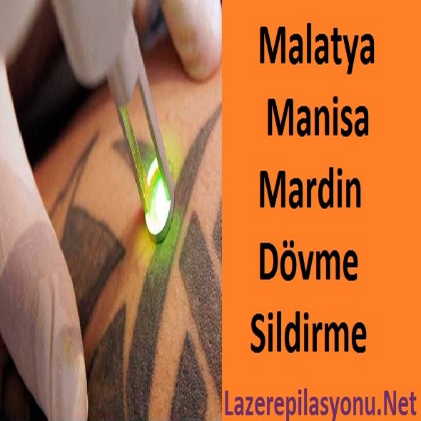 Malatya Manisa Mardin Dövme Sildirme