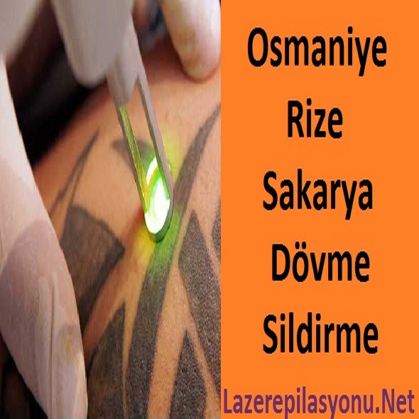 Osmaniye Rize Sakarya Dövme Sildirme
